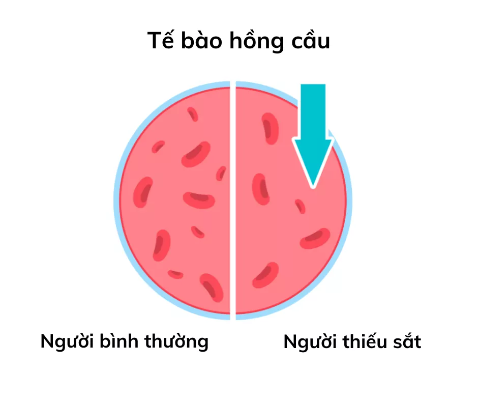 Sự khác biệt giữa hồng cầu của người bình thường và người thiếu máu do thiếu sắt